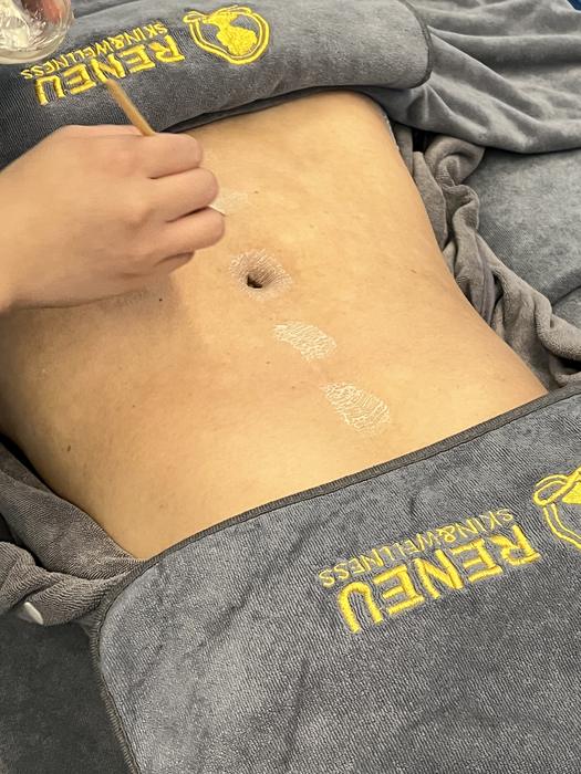 The herbal base laid over the abdomen