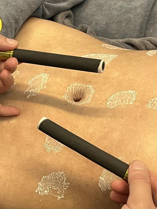 Two moxa sticks warming the abdomen